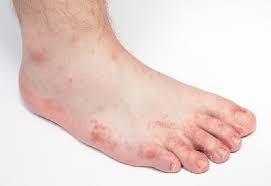 foot infection